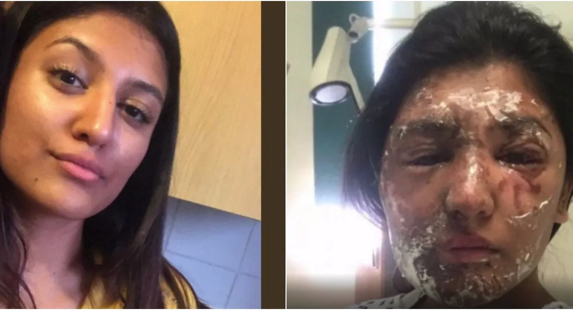 Muslim Girl Badly Injured in London Acid Attack on Her 21st Birthday