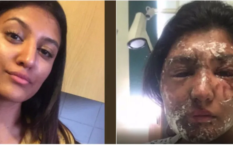 Muslim Girl Badly Injured in London Acid Attack on Her 21st Birthday