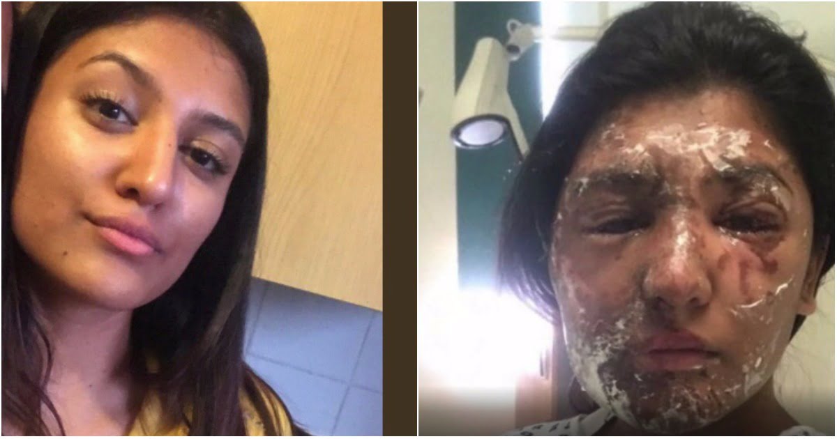 Muslim Girl Badly Injured in London Acid Attack on Her 21st Birthday