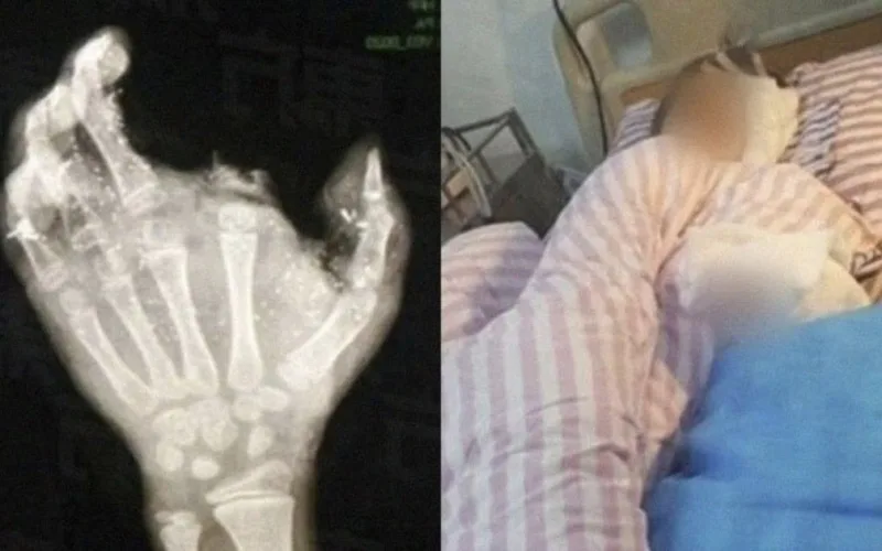 Kid Losses His Finger and Eye After His Phone Explodes While Charging 1