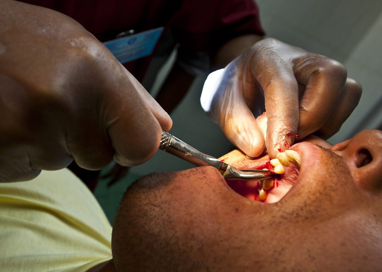 Does Tooth Extraction Breaks Fast