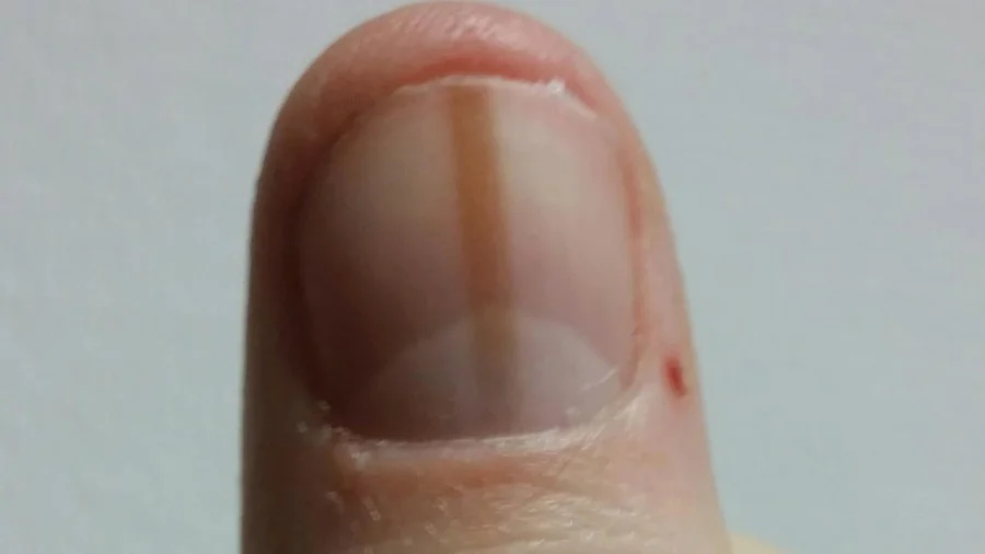 Black lines on the nail cure
