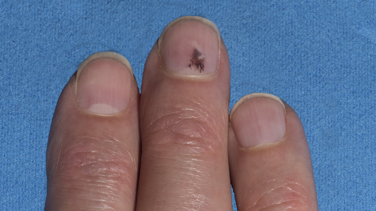 nail black spot cure
