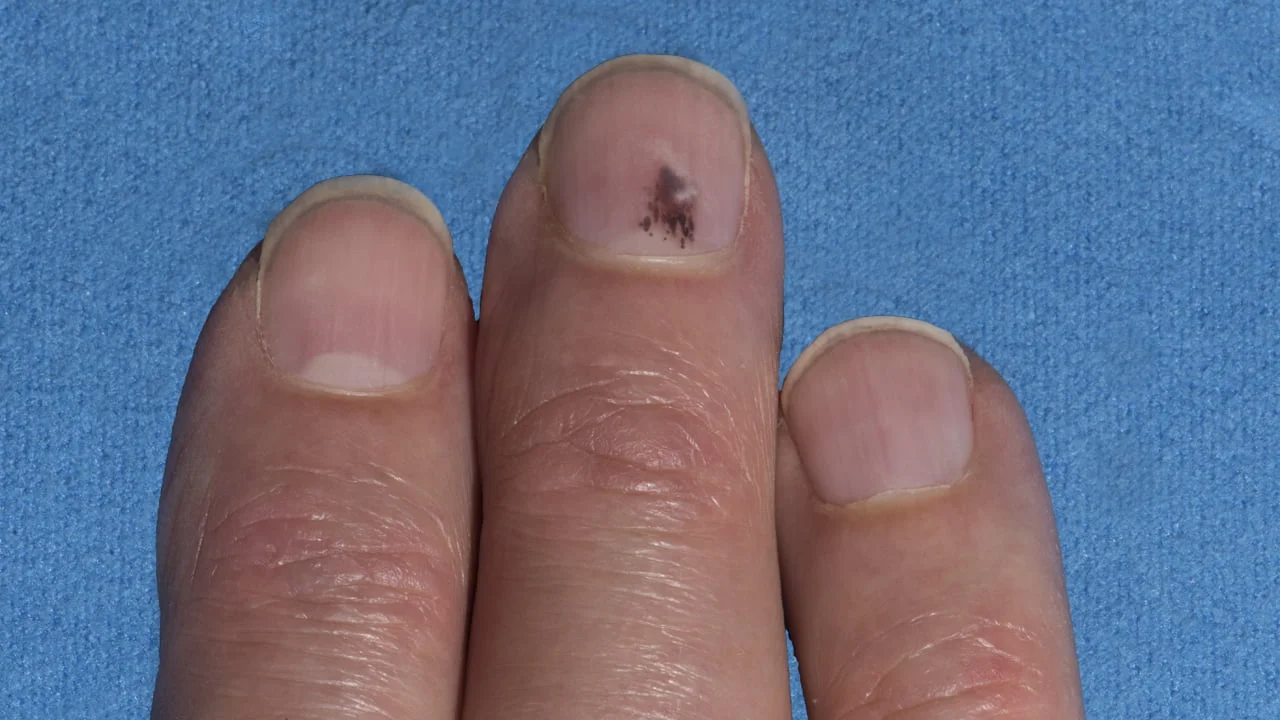 Nail Black Spot Cure 