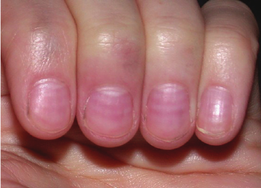 this-is-what-does-the-color-of-your-nails-tell-about-your-health