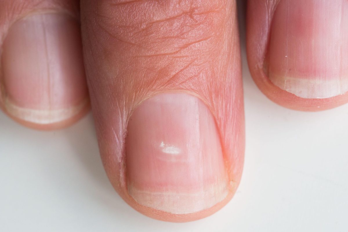 white marks on nails cure