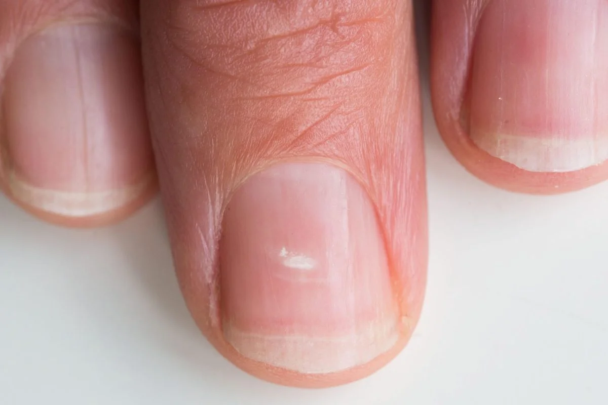 white marks on nails cure