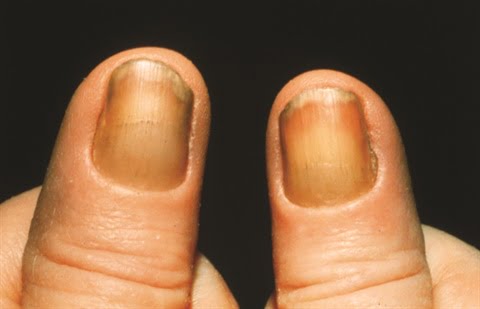 This Is What Does The Color of Your Nails Tell About Your Health