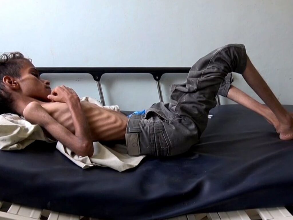 yemen starvation