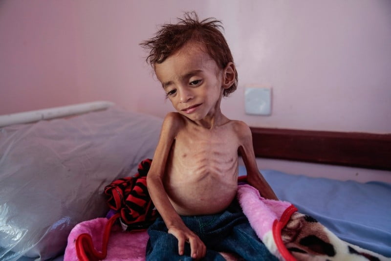 A Malnourished Yemeni Toddler 1