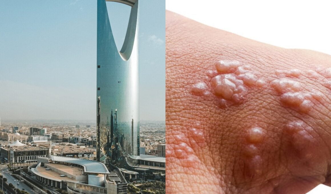 First Monkeypox Case in Saudi Arabia