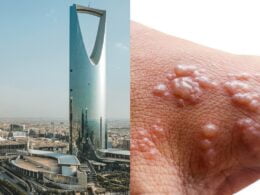 First Monkeypox Case in Saudi Arabia